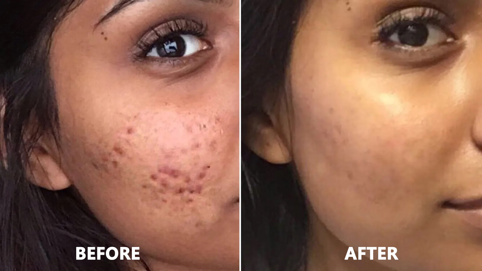 acne-routine-before-and-after1.jpg